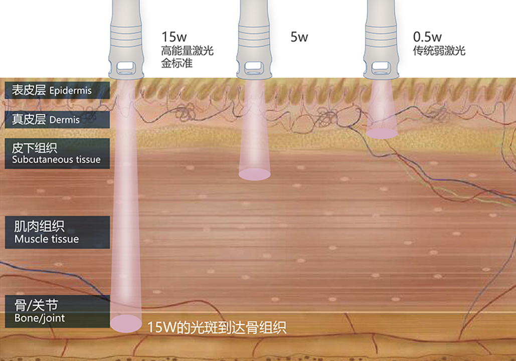 武汉芸禾 半导体激光治疗仪 SAT-G30产品优势