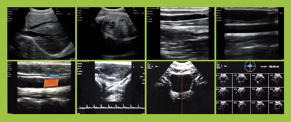 索诺星 SonoStar 全数字超声显像诊断仪 CProbe（腔内）产品优势