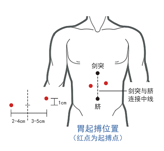 优卓 中频治疗仪（胃肠动力治疗仪） YZ-ZP-D（豪华版）使用方法