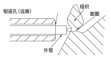 南京微创 一次性使用圈套器  φ24mm×2300mm（10支/盒 10盒/箱）使用方法