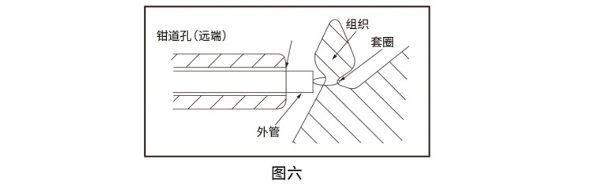 南京微创 一次性使用圈套器  φ24mm×1800mm（10支/盒 10盒/箱）使用方法