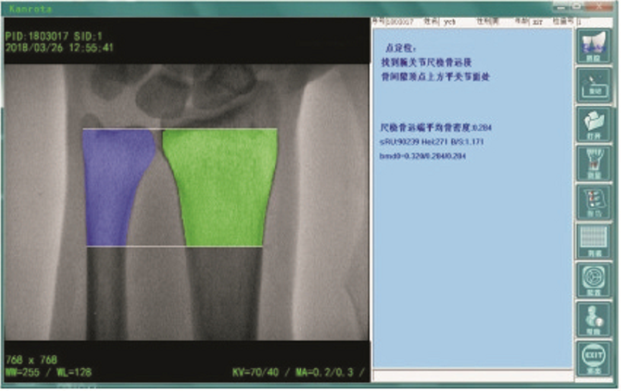 康荣信 数字化双能X射线骨密度仪 DEXA-iMAX Ⅱ产品细节