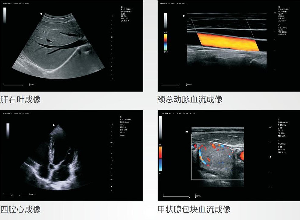 中旗 Zoncare 彩色多普勒超声系统 ZONCARE-V5（主机+腹部探头）产品优势