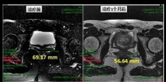 高科恒大GKHD 二氧化碳激光治疗机 （私密激光）CHX-100H（国产玻璃管）产品细节