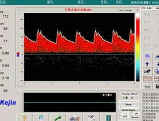 科进Kejin 超声经颅多普勒血流分析仪 KJ-2V6M产品优势