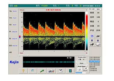 科进Kejin 超声经颅多普勒血流分析仪 KJ-2V6M产品优势