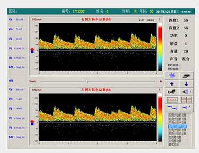 科进Kejin 超声经颅多普勒血流分析仪 KJ-2V6M产品优势