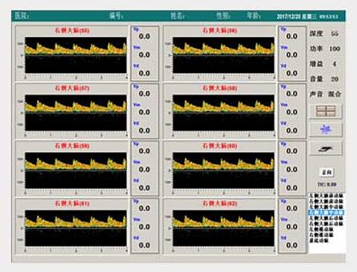 科进Kejin 超声经颅多普勒血流分析仪 KJ-2V6M产品优势