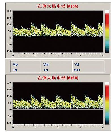 科进Kejin 超声经颅多普勒血流分析仪 KJ-2V6M+产品细节