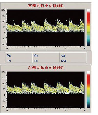 科进Kejin 超声经颅多普勒血流分析仪 KJ-2V6M+产品细节