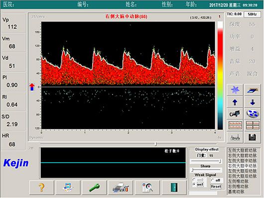 科进Kejin 超声经颅多普勒血流分析仪 KJ-2V7M产品优势