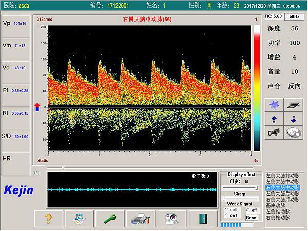 科进Kejin 超声经颅多普勒血流分析仪 KJ-2V7M产品优势